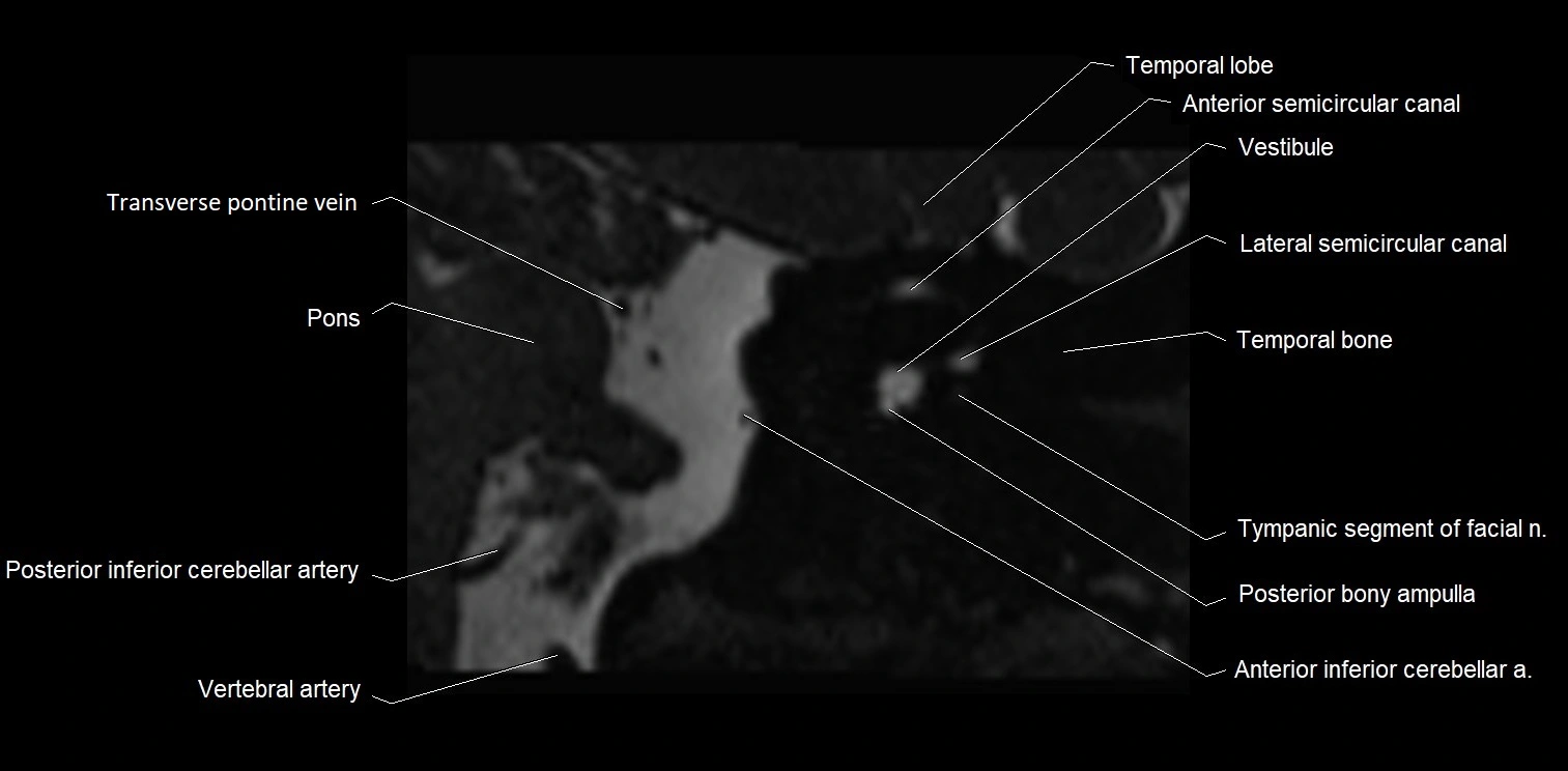 MRI Internal auditory meatus (IAM) coronal cross sectional labelled anatomy image 21.webp